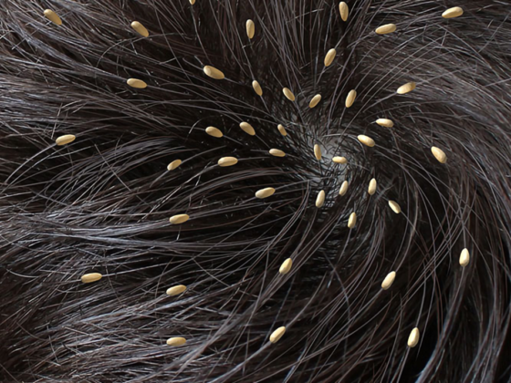 பேன் பொடுகு நீங்க என்ன செய்யலாம்? 1 பேன் பொடுகு நீங்க என்ன செய்யலாம்?