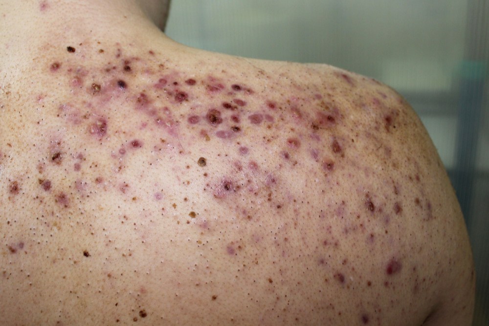 முதுகு பருக்கான சிகிச்சை உங்களுக்குத் தெரியுமா? 4 முதுகு பருக்கான சிகிச்சை உங்களுக்குத் தெரியுமா?