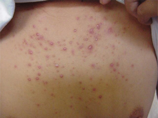 முதுகு பருக்கான சிகிச்சை உங்களுக்குத் தெரியுமா? 2 முதுகு பருக்கான சிகிச்சை உங்களுக்குத் தெரியுமா?